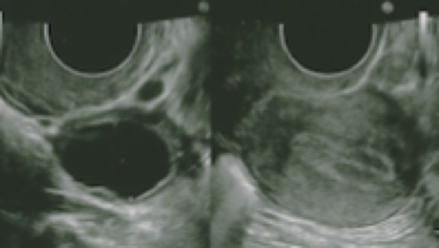 Echographie : Follicule mature (à gauche) / Muqueuse utérine triple feuillet ( à droite)